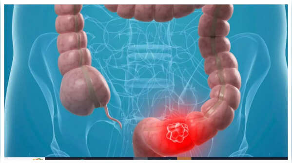 Illustration of blood in stool.