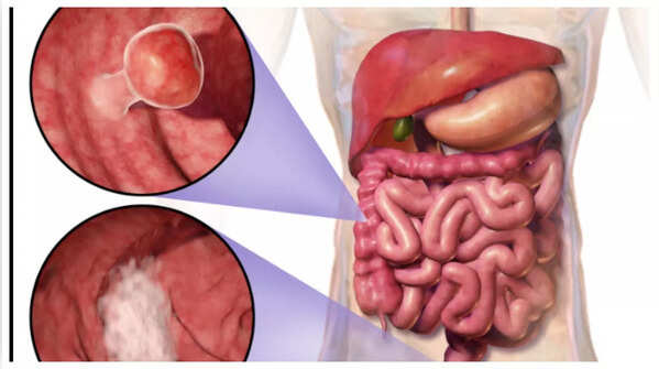 Illustration of changes in bowel habits.